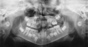 Pediatric Dentist in Owings Mills, MD - Dental Radiographs (X-Rays)