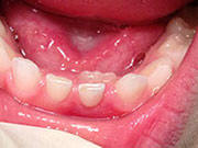 Baby Teeth - Pediatric Dentist in Owings Mills, MD